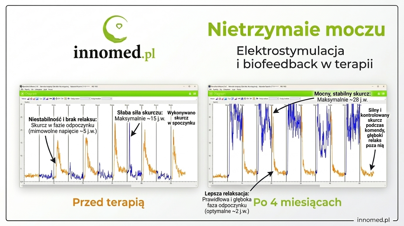 Infografika: nietrzymanie moczu - elektrostymulacja i EMG biofeedback w terapii dna miednicy