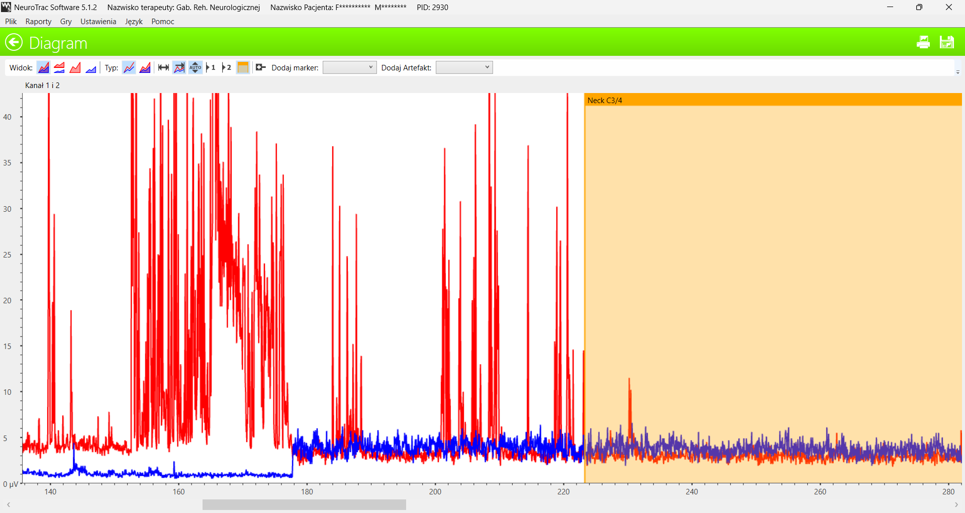 Wykres EMG napięcia spoczynkowego zwieraczy - niestabilne napięcie normalizuje się po rozciągnięciu mięśni karku (Neck C3/4)